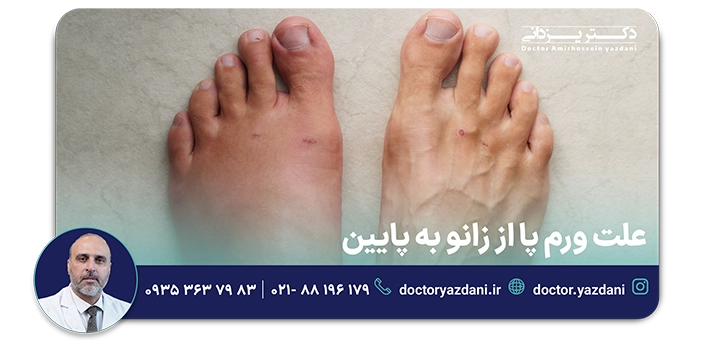 علت ورم پا از زانو به پایین